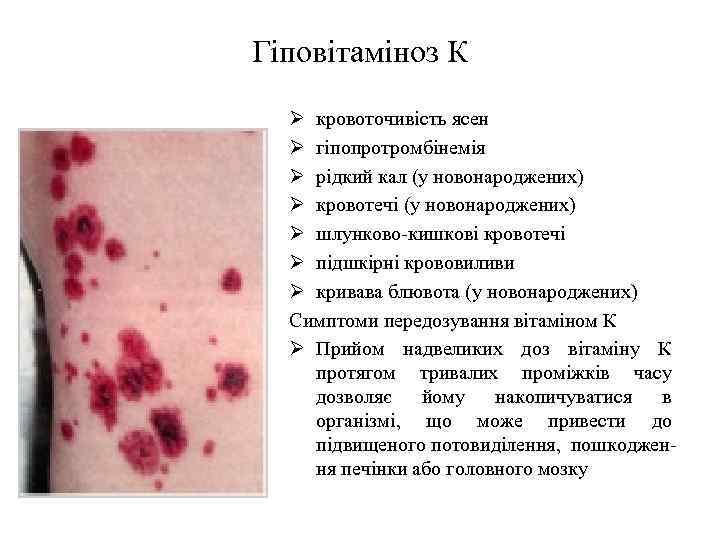 Гіповітаміноз К Ø кровоточивість ясен Ø гіпопротромбінемія Ø рідкий кал (у новонароджених) Ø кровотечі