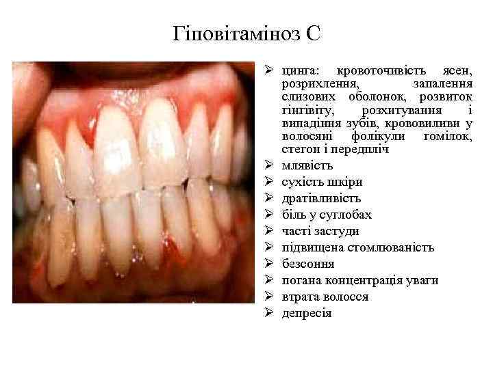Гіповітаміноз С Ø цинга: кровоточивість ясен, розрихлення, запалення слизових оболонок, розвиток гінгівіту, розхитування і