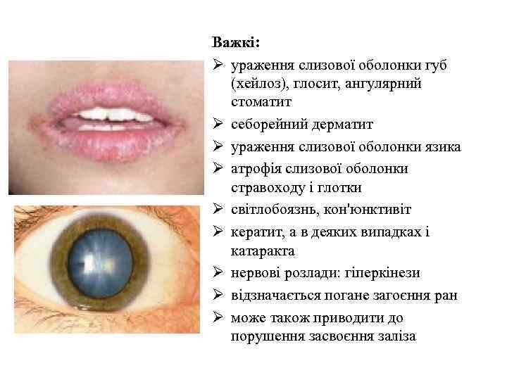 Важкі: Ø ураження слизової оболонки губ (хейлоз), глосит, ангулярний стоматит Ø себорейний дерматит Ø