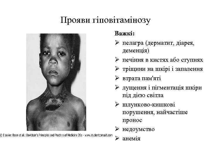 Прояви гіповітамінозу Важкі: Ø пелагра (дерматит, діарея, деменція) Ø печіння в кистях або ступнях