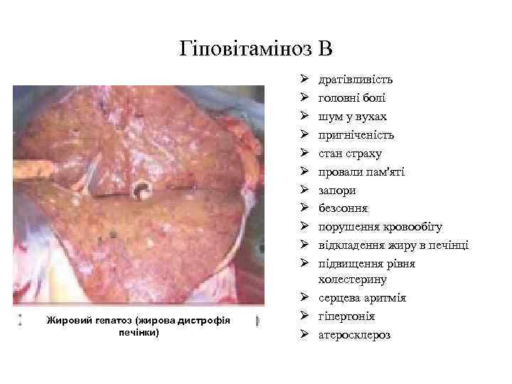 Гіповітаміноз В Ø Ø Ø Жировий гепатоз (жирова дистрофія печінки) дратівливість головні болі шум