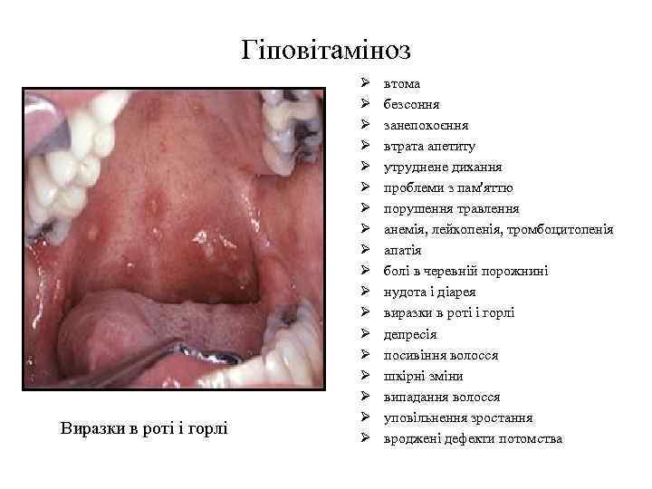 Гіповітаміноз Виразки в роті і горлі Ø Ø Ø Ø Ø втома безсоння занепокоєння