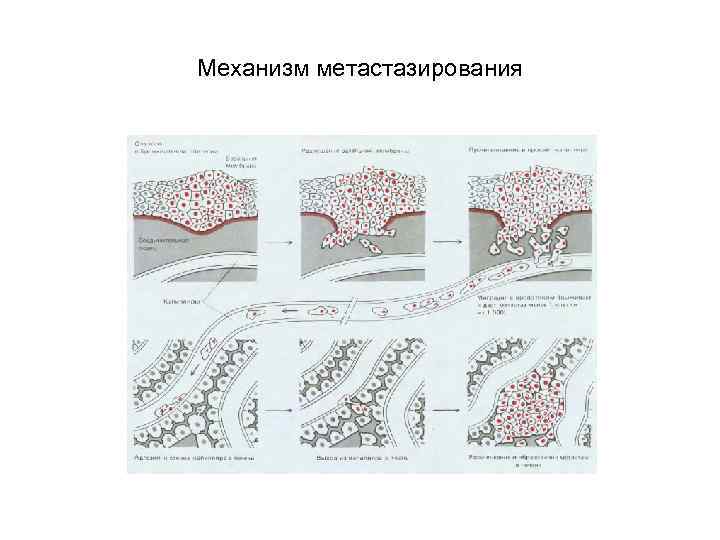 Механизм метастазирования 