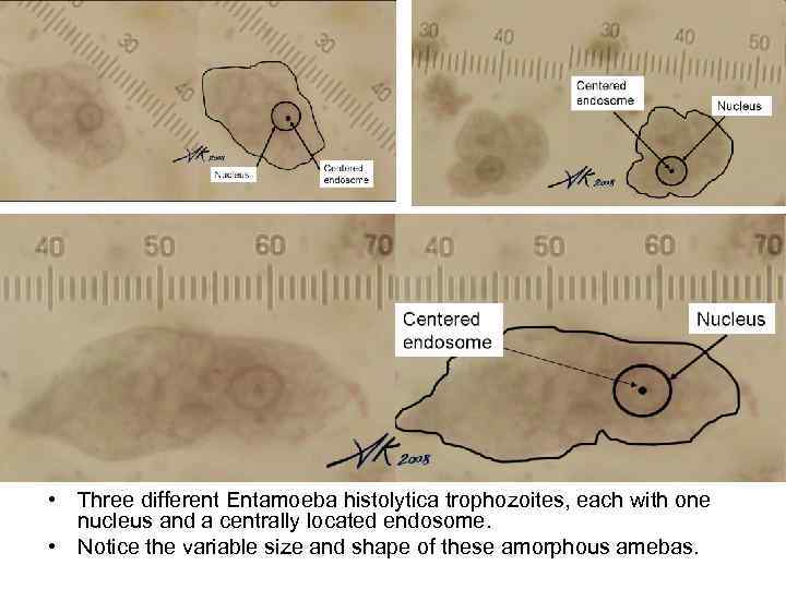  • Three different Entamoeba histolytica trophozoites, each with one nucleus and a centrally