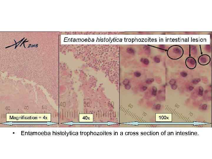  • Entamoeba histolytica trophozoites in a cross section of an intestine. 