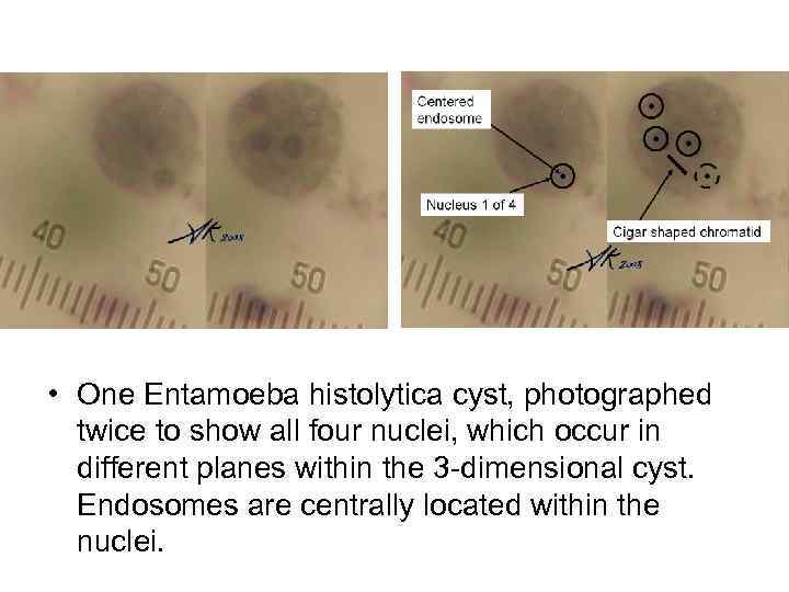  • One Entamoeba histolytica cyst, photographed twice to show all four nuclei, which