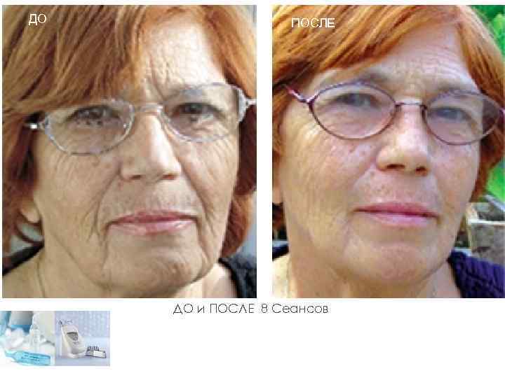 ДО ПОСЛЕ ДО и ПОСЛЕ 8 Сеансов 