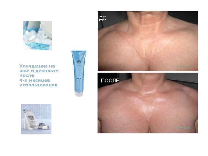 ДО Улучшение на шее и декольте после 4 -х месяцев использования ПОСЛЕ 