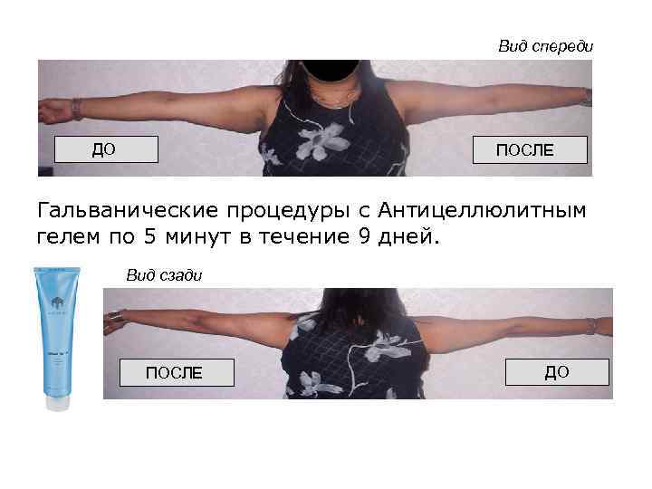 Вид спереди ДО ПОСЛЕ Гальванические процедуры с Антицеллюлитным гелем по 5 минут в течение