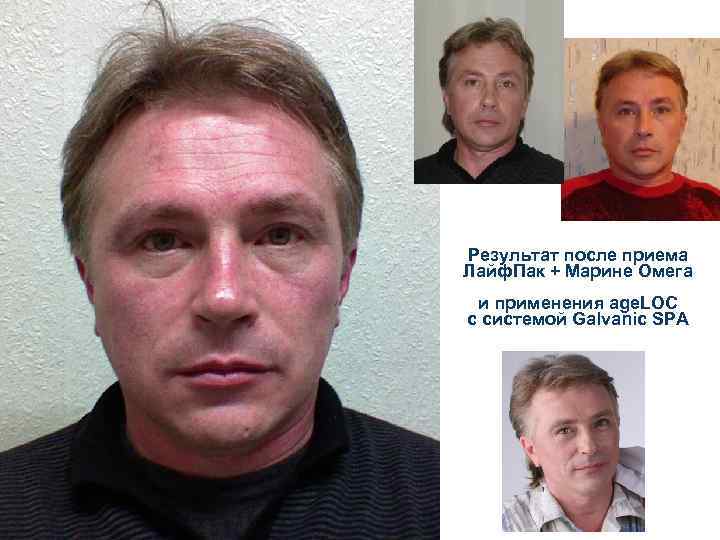 Результат после приема Лайф. Пак + Марине Омега и применения age. LOC c системой