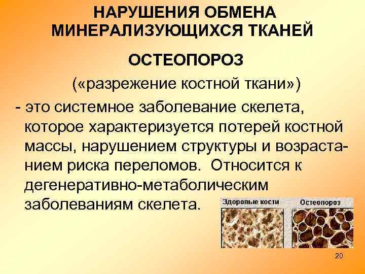  НАРУШЕНИЯ ОБМЕНА МИНЕРАЛИЗУЮЩИХСЯ ТКАНЕЙ ОСТЕОПОРОЗ ( «разрежение костной ткани» ) - это системное