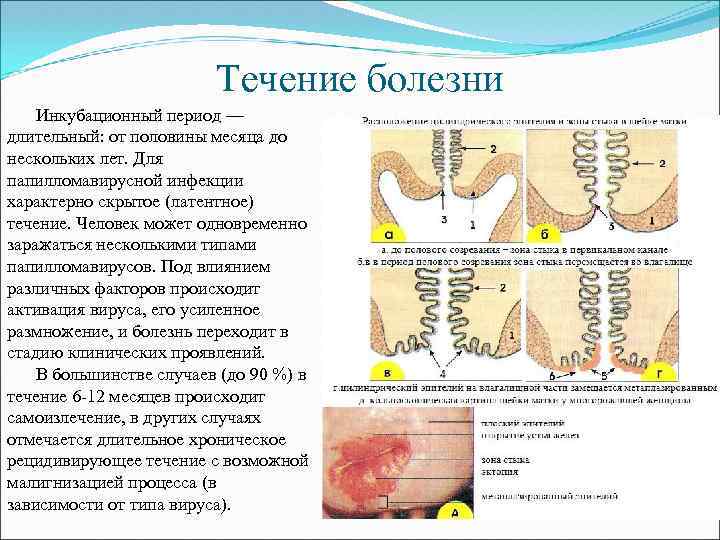 Течение болезни Инкубационный период — длительный: от половины месяца до нескольких лет. Для папилломавирусной