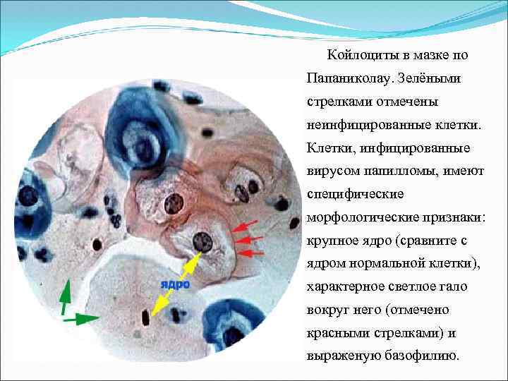 Гигантская кондилома бушке левенштейна фото