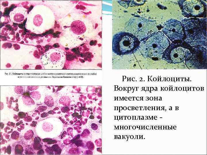 Рис. 2. Койлоциты. Вокруг ядра койлоцитов имеется зона просветления, а в цитоплазме многочисленные вакуоли.