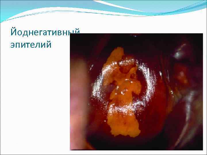 Йоднегативный эпителий 