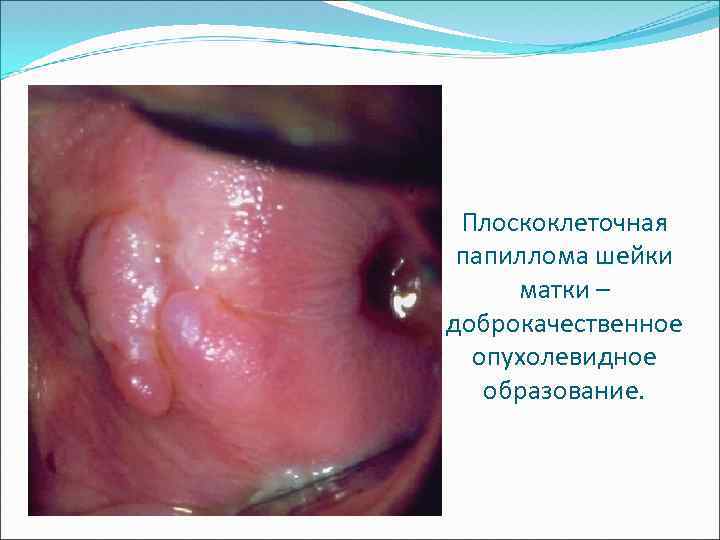 Плоскоклеточная папиллома шейки матки – доброкачественное опухолевидное образование. 