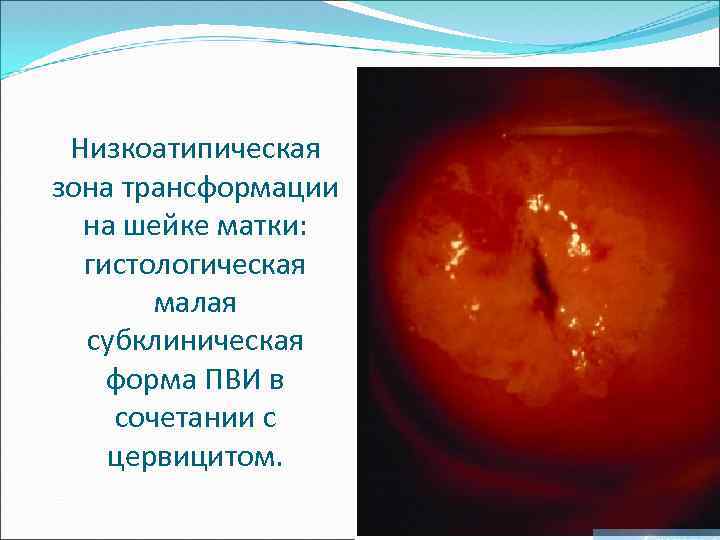 Низкоатипическая зона трансформации на шейке матки: гистологическая малая субклиническая форма ПВИ в сочетании с