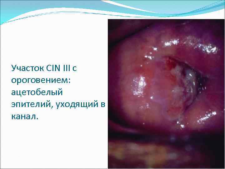 Участок CIN III c ороговением: ацетобелый эпителий, уходящий в канал. 