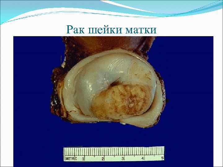 Рак шейки матки 