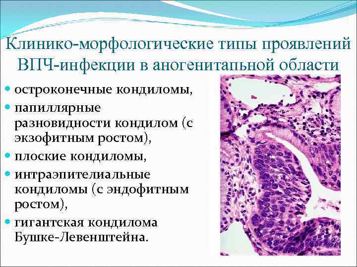 Клинико-морфологические типы проявлений ВПЧ-инфекции в аногенитапьной области остроконечные кондиломы, папиллярные разновидности кондилом (с экзофитным