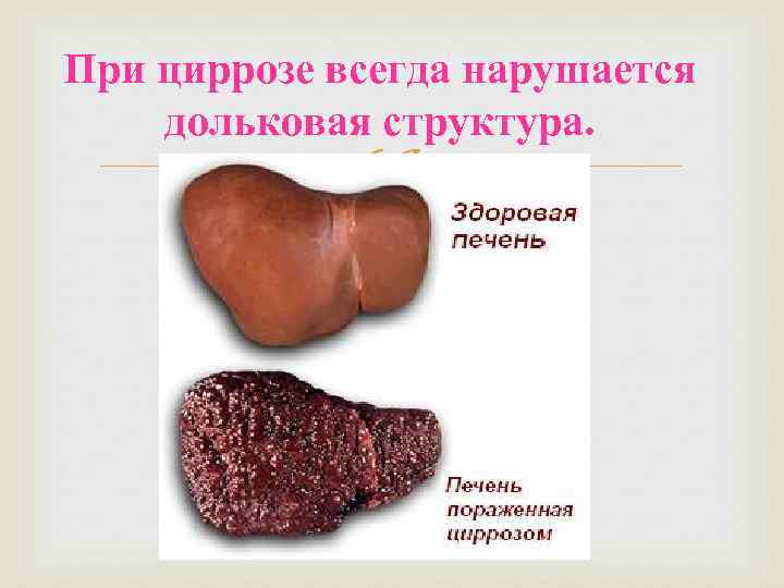 При циррозе всегда нарушается дольковая структура. 