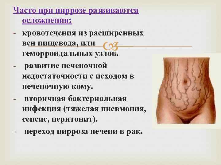 Часто при циррозе развиваются осложнения: - кровотечения из расширенных вен пищевода, или геморроидальных узлов.