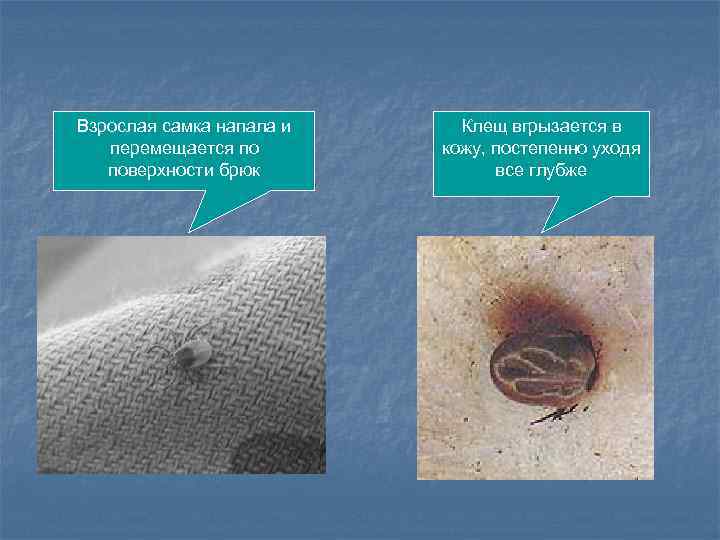 Взрослая самка напала и перемещается по поверхности брюк Клещ вгрызается в кожу, постепенно уходя