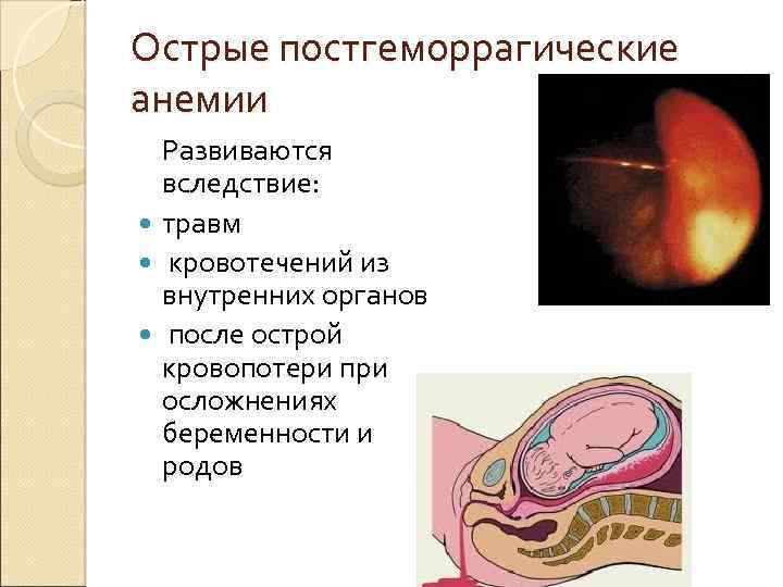 Острые постгеморрагические анемии Развиваются вследствие: травм кровотечений из внутренних органов после острой кровопотери при