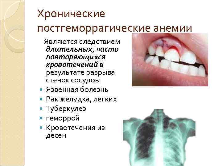 Хронические постгеморрагические анемии Являются следствием длительных, часто повторяющихся кровотечений в результате разрыва стенок сосудов: