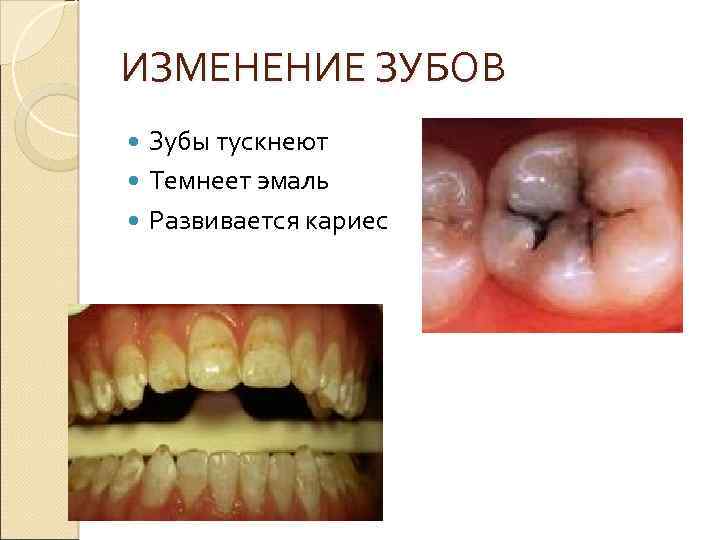 ИЗМЕНЕНИЕ ЗУБОВ Зубы тускнеют Темнеет эмаль Развивается кариес 