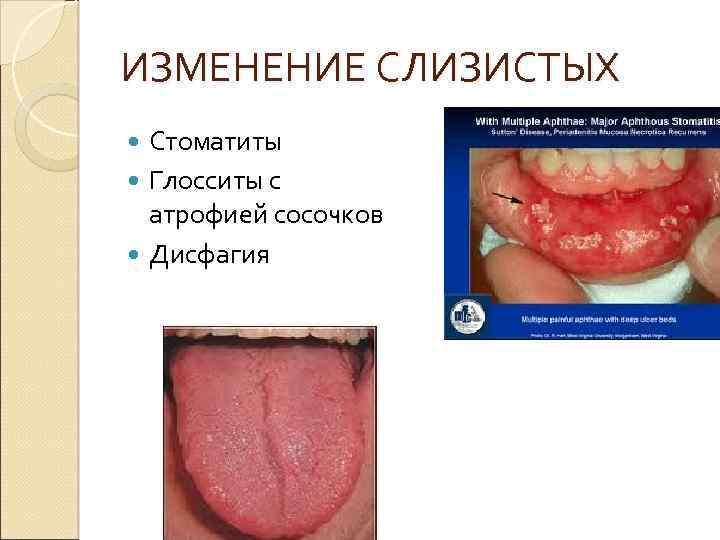 ИЗМЕНЕНИЕ СЛИЗИСТЫХ Стоматиты Глосситы с атрофией сосочков Дисфагия 