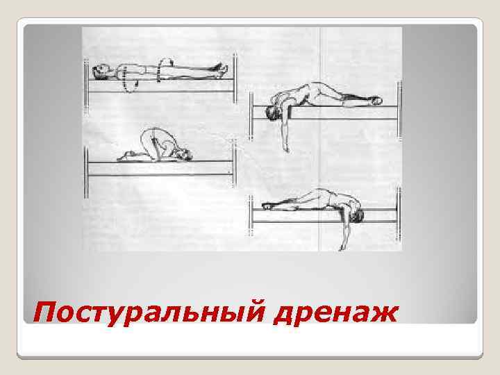 Постуральный дренаж 