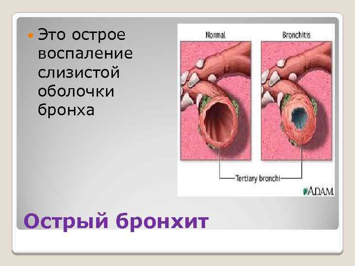  Это острое воспаление слизистой оболочки бронха Острый бронхит 
