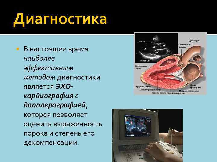 Диагностика В настоящее время наиболее эффективным методом диагностики является ЭХОкардиография с допплерографией, которая позволяет