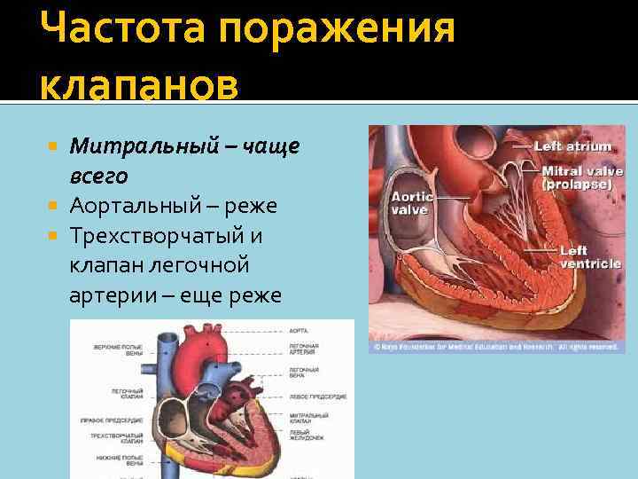 Частота поражения клапанов Митральный – чаще всего Аортальный – реже Трехстворчатый и клапан легочной