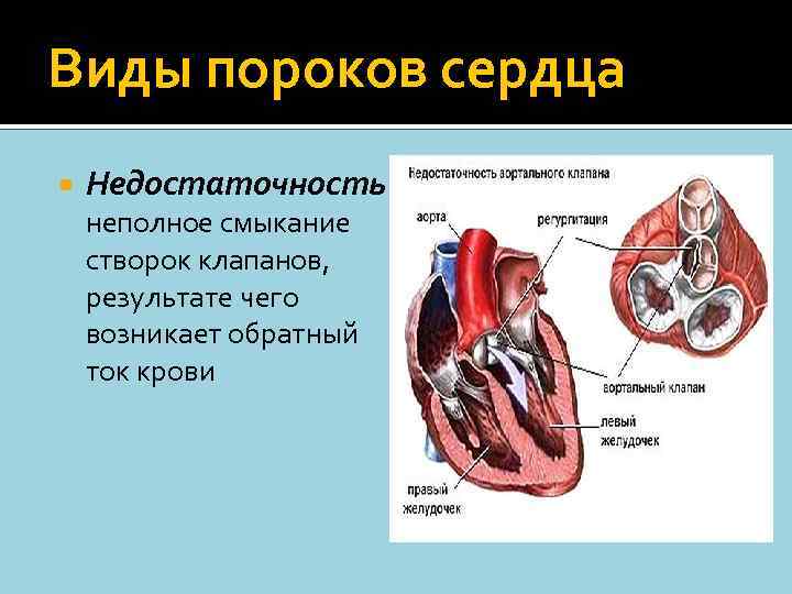 Виды пороков сердца Недостаточность – неполное смыкание створок клапанов, результате чего возникает обратный ток