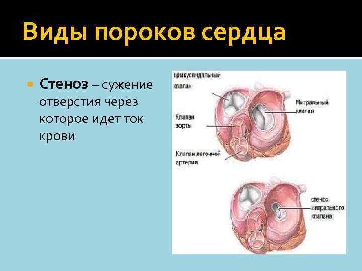 Виды пороков сердца Стеноз – сужение отверстия через которое идет ток крови 