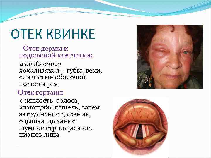 ОТЕК КВИНКЕ Отек дермы и подкожной клетчатки: излюбленная локализация – губы, веки, слизистые оболочки
