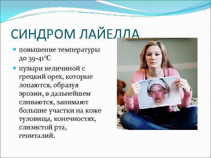 СИНДРОМ ЛАЙЕЛЛА повышение температуры до 39 -41°С пузыри величиной с грецкий орех, которые лопаются,