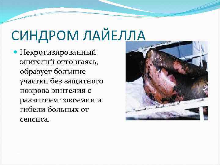 СИНДРОМ ЛАЙЕЛЛА Некротизированный эпителий отторгаясь, образует большие участки без защитного покрова эпителия с развитием