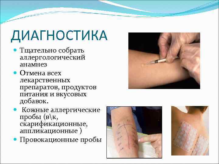 ДИАГНОСТИКА Тщательно собрать аллергологический анамнез Отмена всех лекарственных препаратов, продуктов питания и вкусовых добавок.