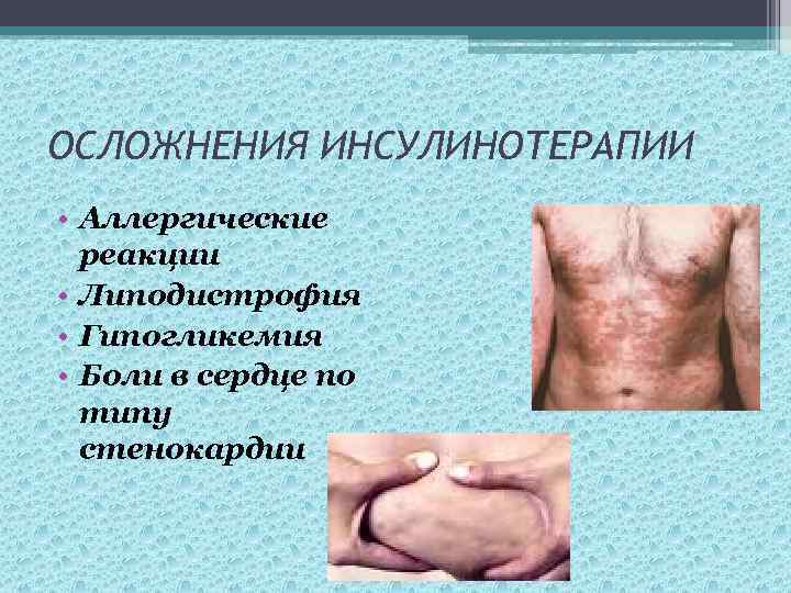 ОСЛОЖНЕНИЯ ИНСУЛИНОТЕРАПИИ • Аллергические реакции • Липодистрофия • Гипогликемия • Боли в сердце по