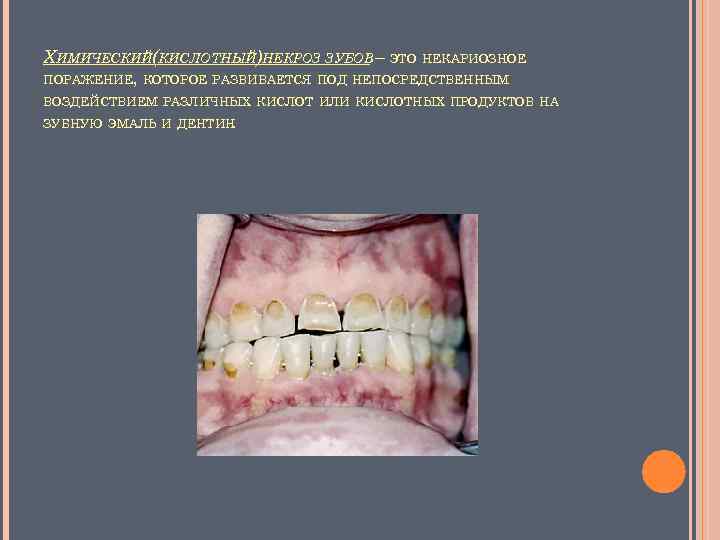 Радиационный некроз зубов фото