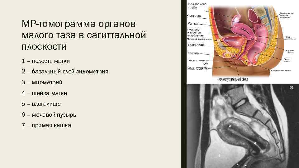 МР-томограмма органов малого таза в сагиттальной плоскости 1 – полость матки 2 – базальный