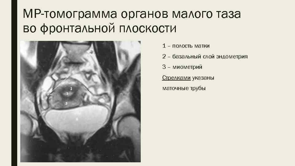 МР-томограмма органов малого таза во фронтальной плоскости 1 – полость матки 2 – базальный