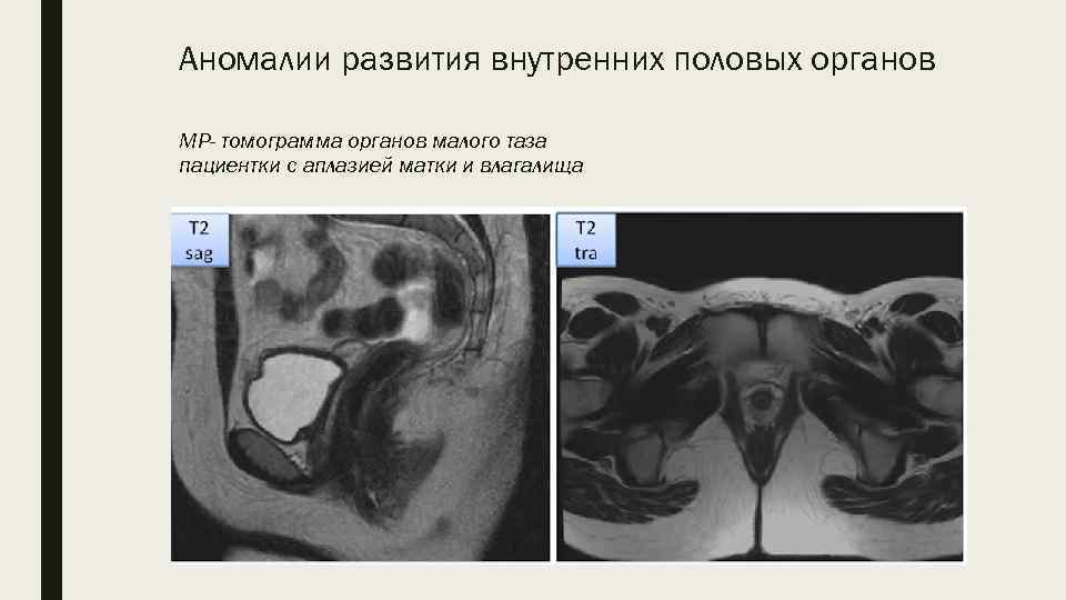 Аномалии развития внутренних половых органов МР- томограмма органов малого таза пациентки с аплазией матки