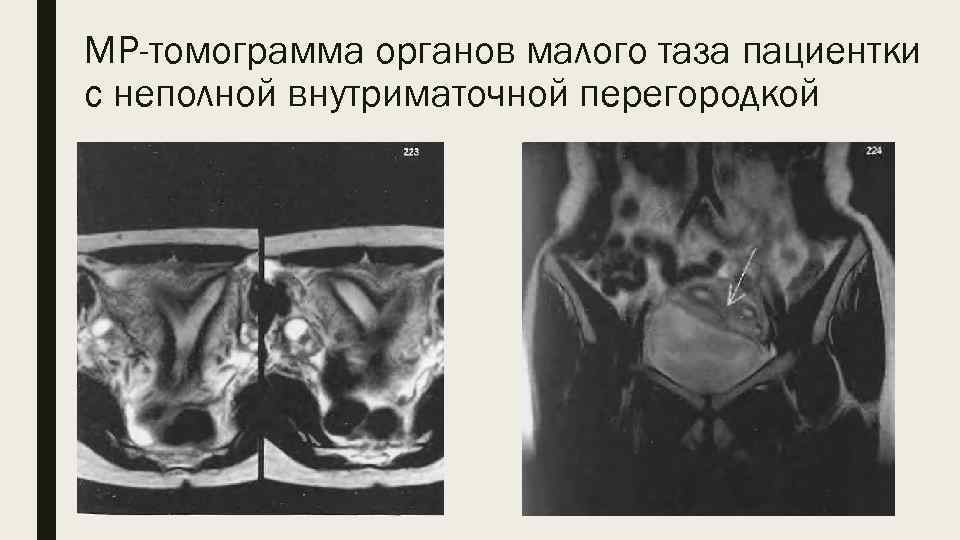 МР-томограмма органов малого таза пациентки с неполной внутриматочной перегородкой 