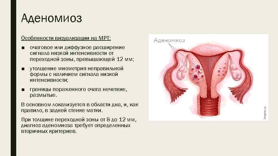 Аденомиоз Особенности визуализации на МРТ: ■ очаговое или диффузное расширение сигнала низкой интенсивности от