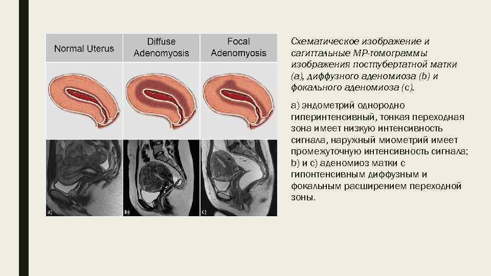 Схематическое изображение и сагиттальные МР-томограммы изображения постпубертатной матки (а), диффузного аденомиоза (b) и фокального