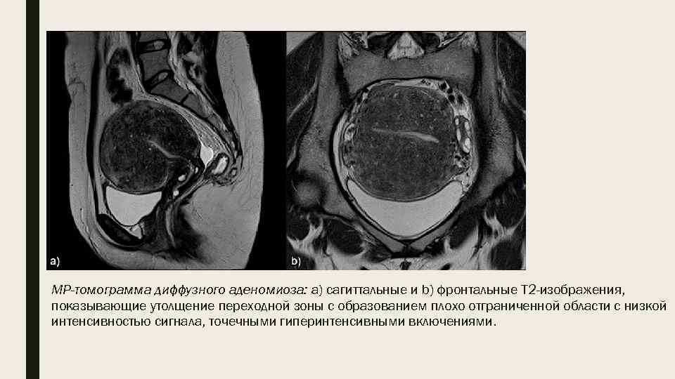 МР-томограмма диффузного аденомиоза: а) сагиттальные и b) фронтальные T 2 -изображения, показывающие утолщение переходной
